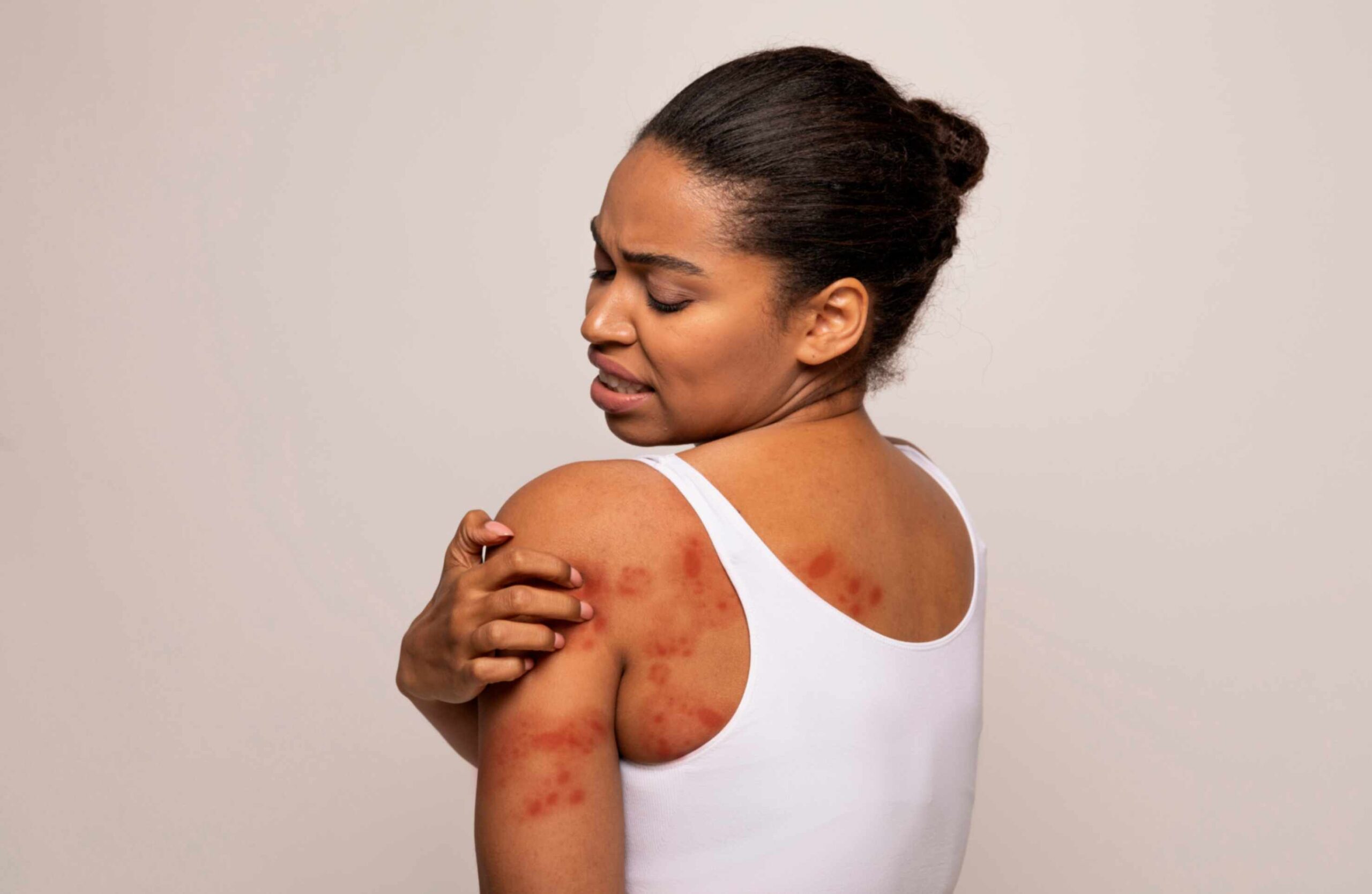 What Is Shingles?