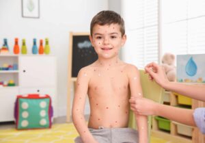 A young child sitting shirtless indoors with visible red spots of chickenpox across their face and body, while an adult applies topical treatment to their arm in a brightly lit playroom.