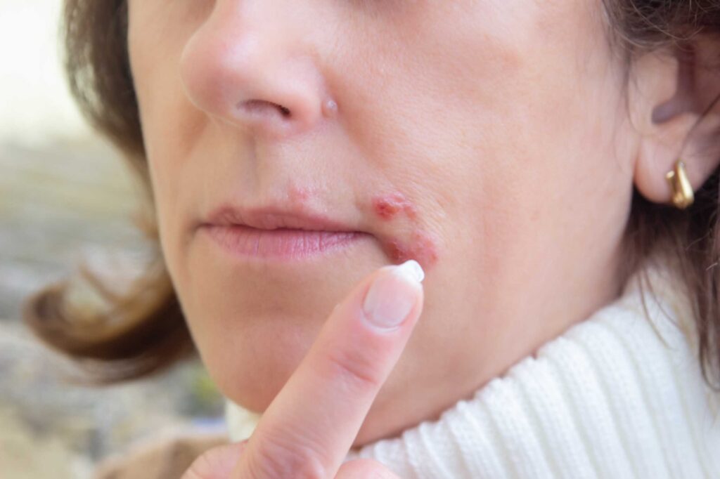 what Is impetigo early signs, treatment and prevention tips