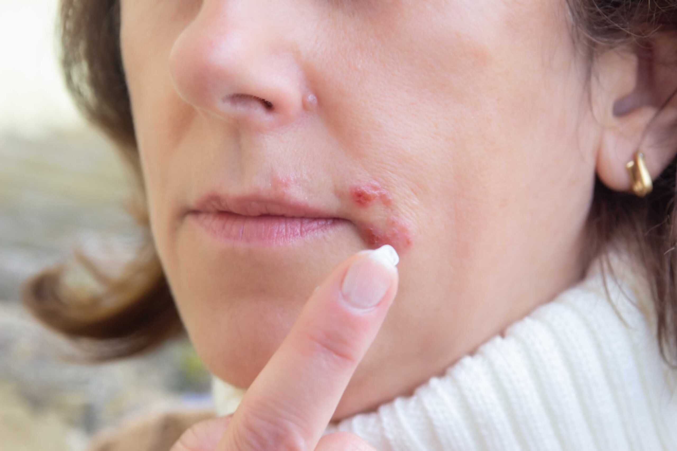 what Is impetigo early signs, treatment and prevention tips