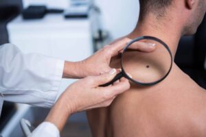 doctor-examines-patient-with-magnifying-glass-in-mole