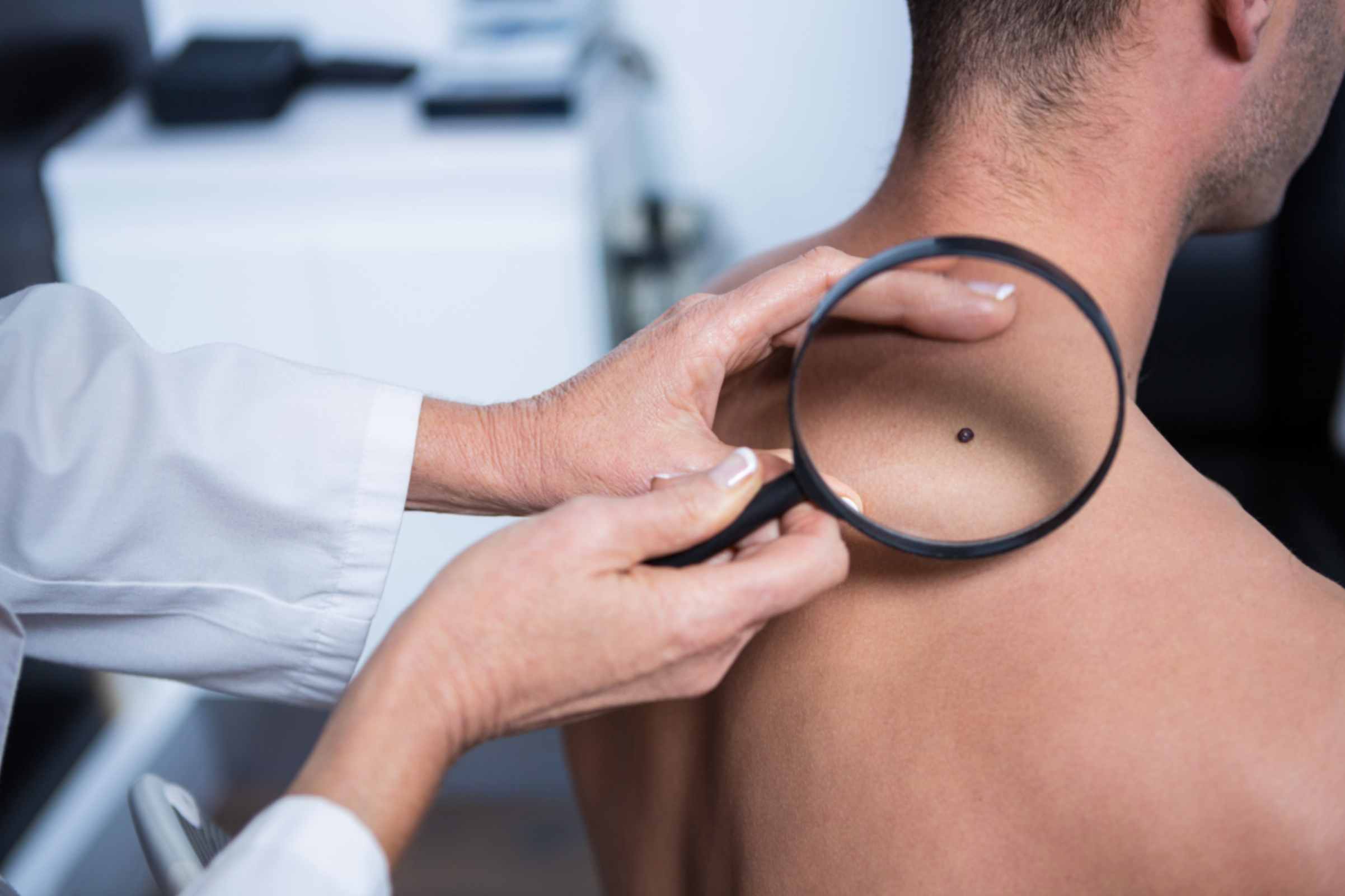 doctor-examines-patient-with-magnifying-glass-in-mole