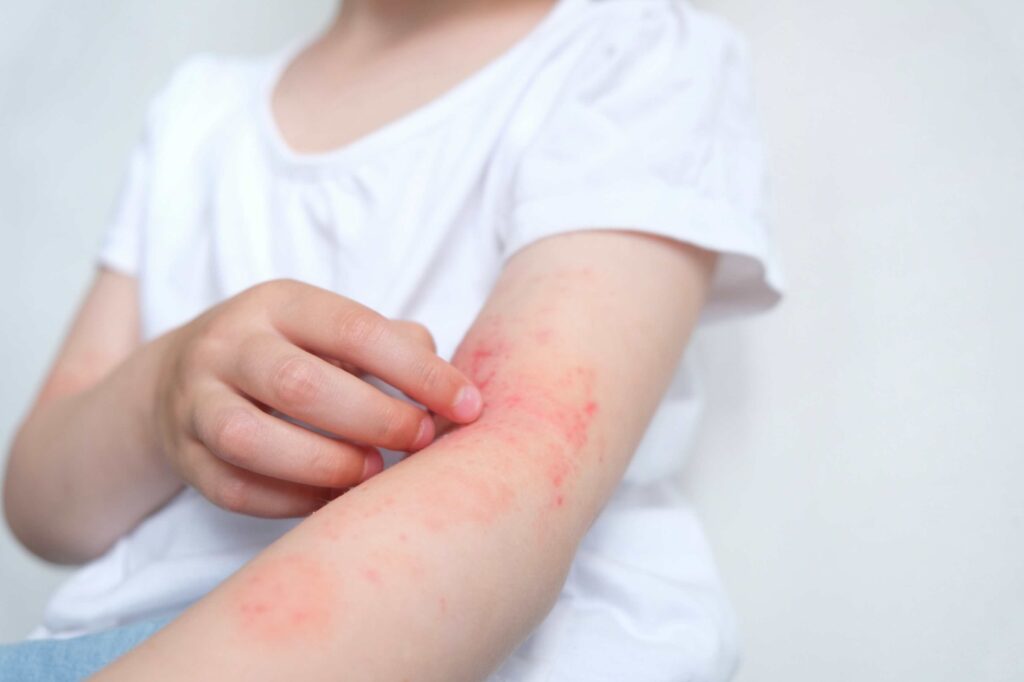 child-with-redness-and-rash-on-arm-facing-infected-insect-bites-symptoms