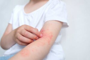 child-with-redness-and-rash-on-arm-facing-infected-insect-bites-symptoms